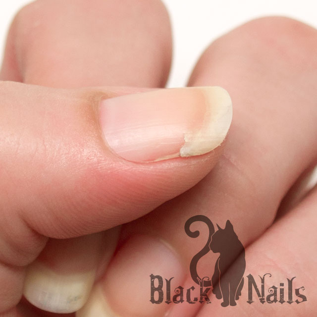 Onycholysis (Nail Lifting) - Nail Disorders - Skin Care ...
